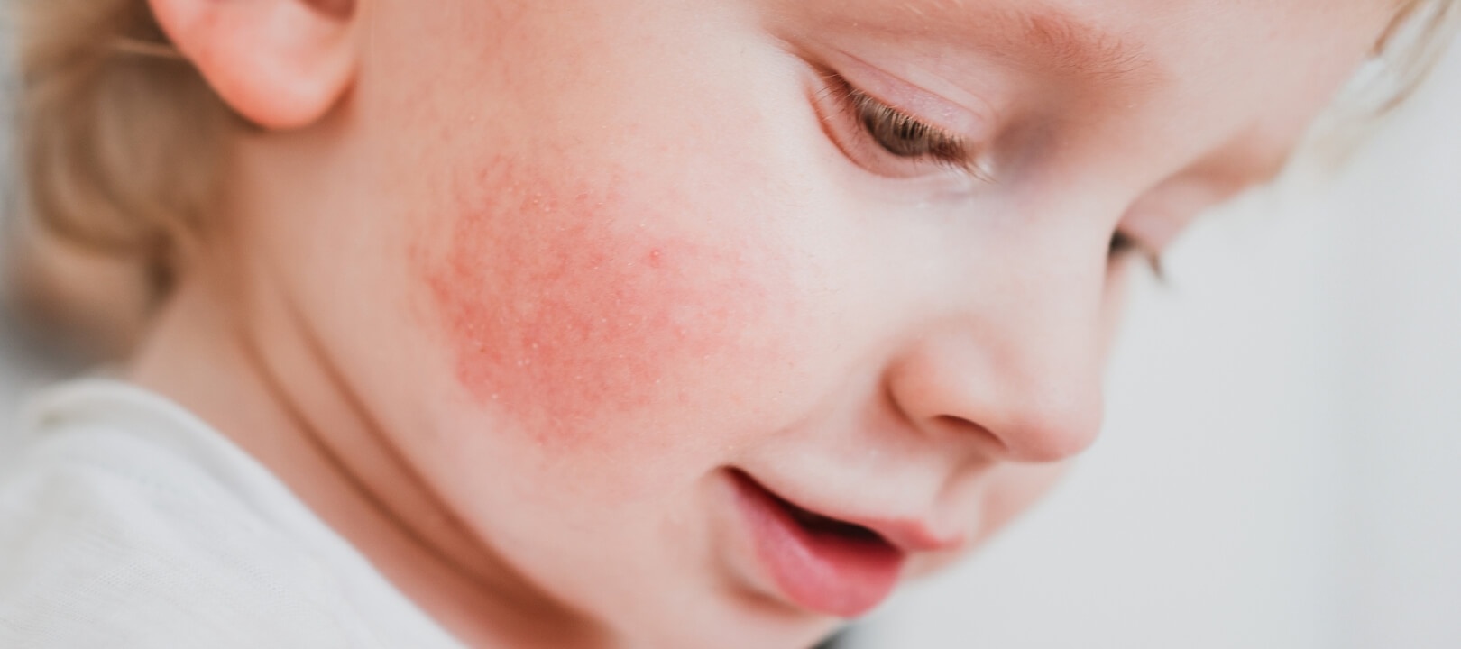 Atopik Dermatit Nedir? Neden Olur ve Nasıl Geçer?