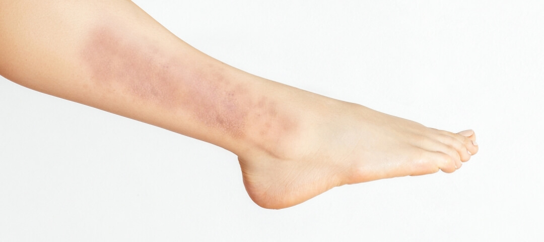 Bacak Egzaması Nedir? Neden Olur? Tedavisi Nasıldır?