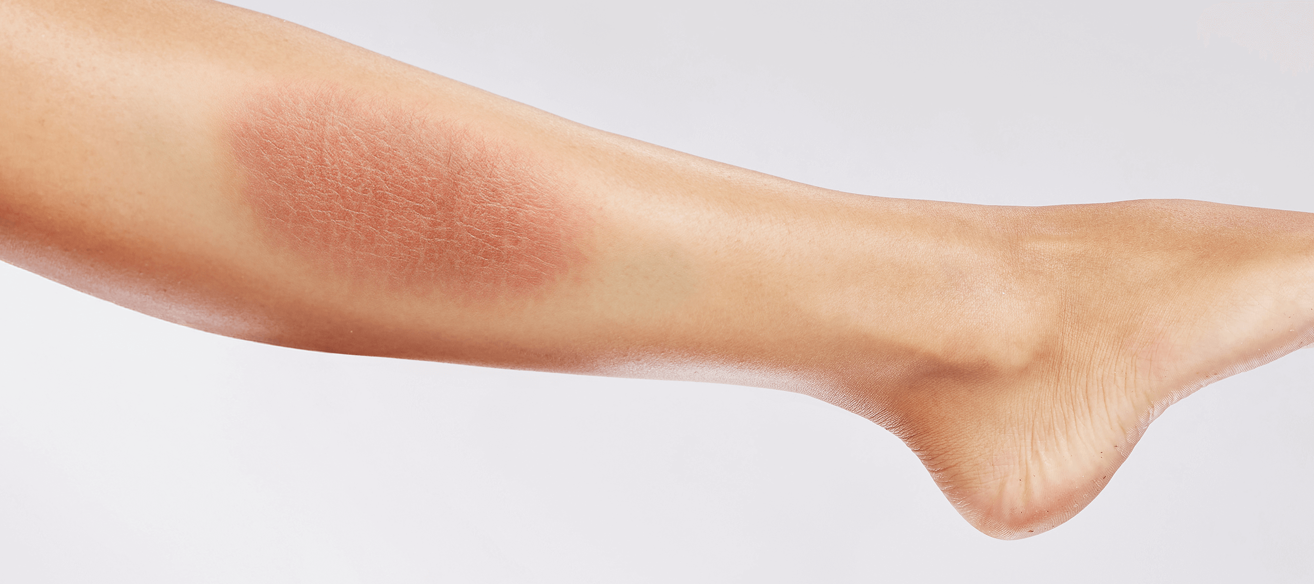 Bacaklarda Kaşıntı Neden Olur? Nasıl Geçer? Dr. Ahmet Acar